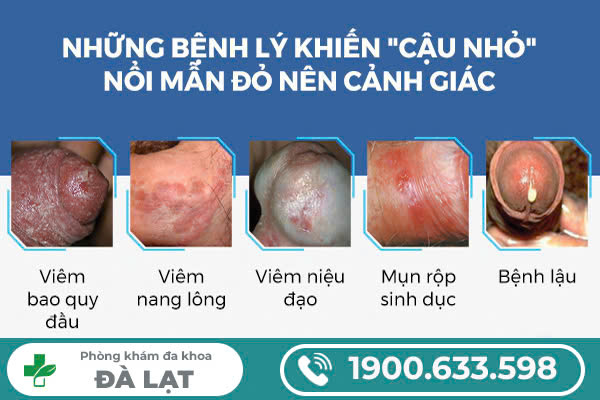 Hình ảnh minh họa