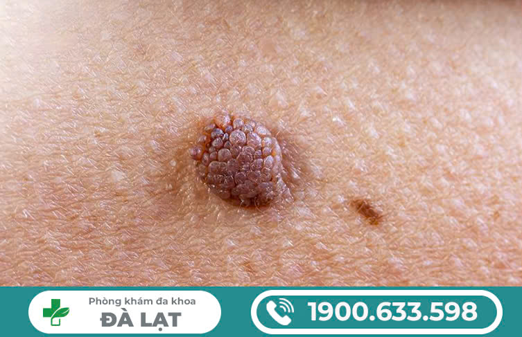 Hình ảnh minh họa