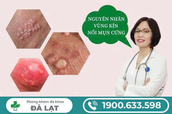 Hình ảnh minh họa