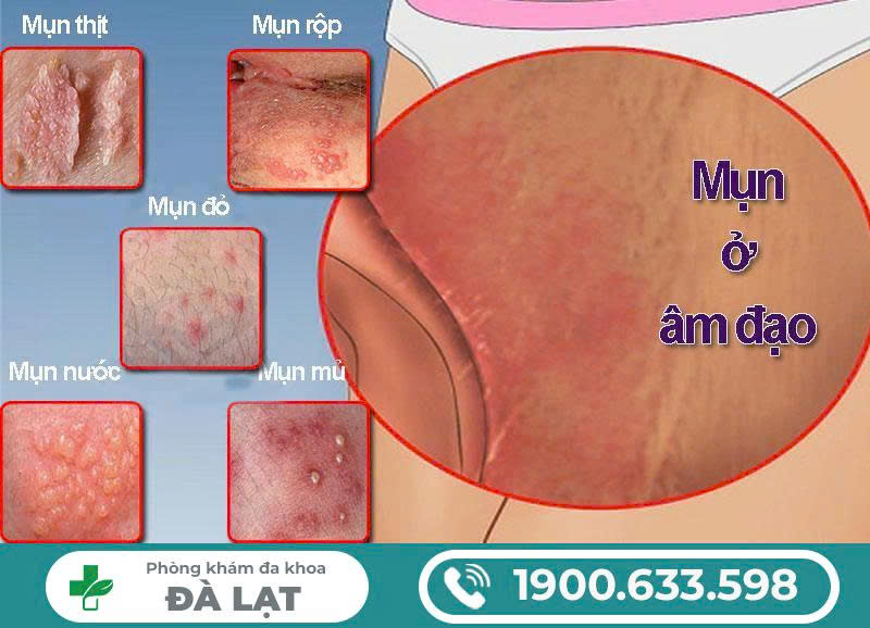 Hình ảnh minh họa