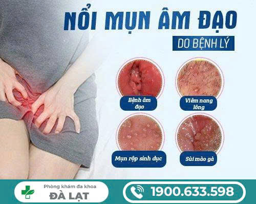 Hình ảnh minh họa