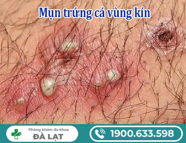 Hình ảnh minh họa