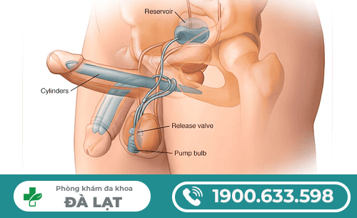 Hình ảnh minh họa