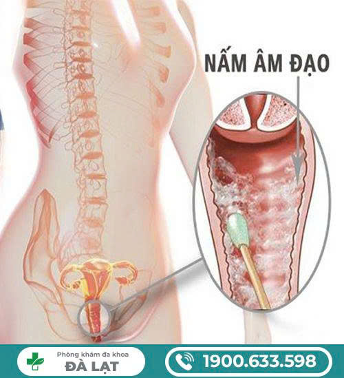 Hình ảnh minh họa